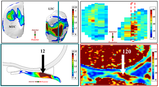 Tensile Stress in Lateral and Medial Tibial Cartilage