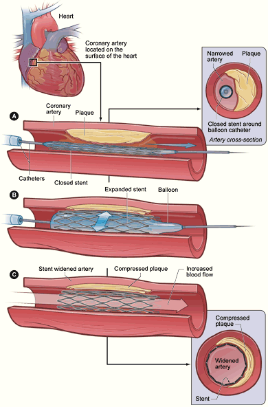 coronary_stent_placement